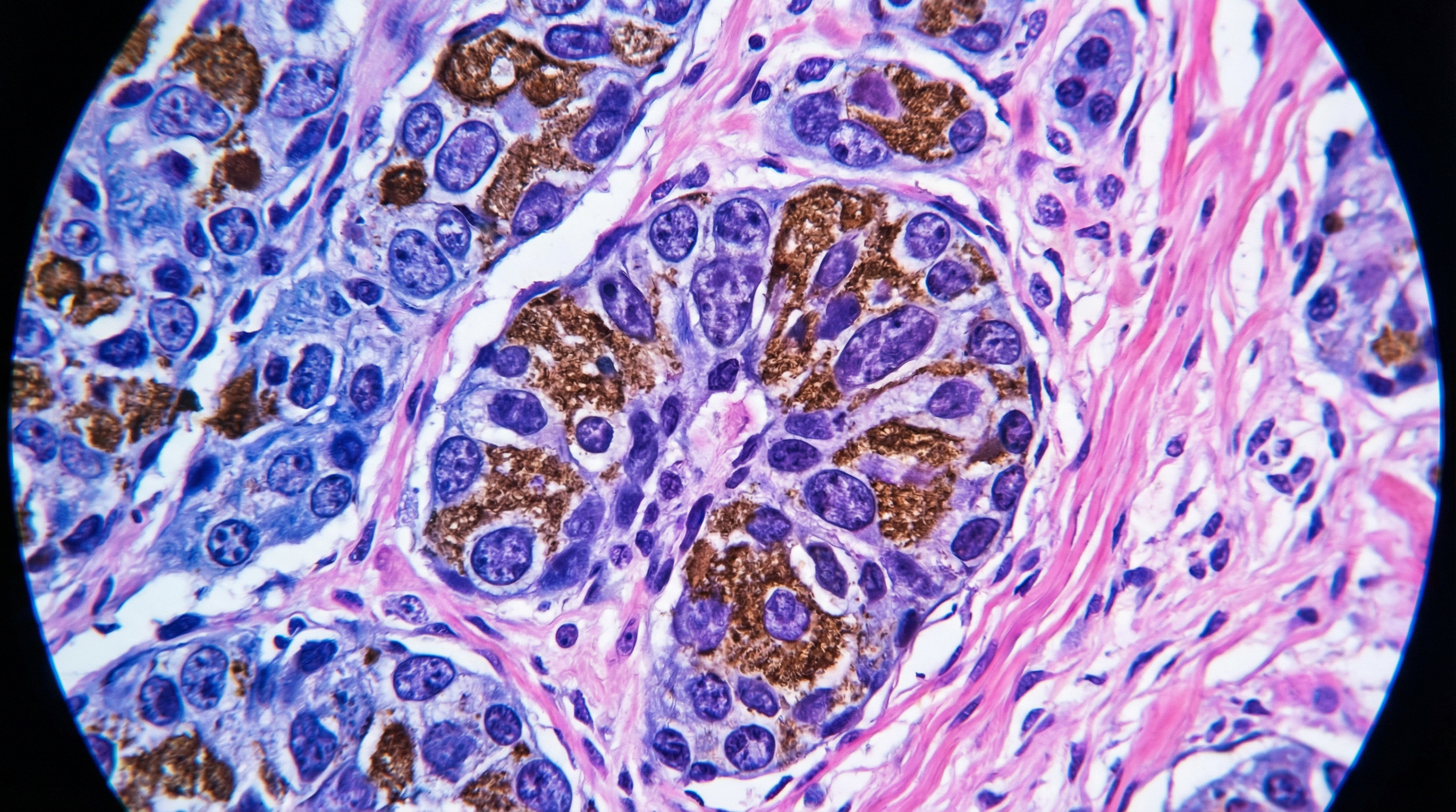 Melanoma histopathology digital pathology slide